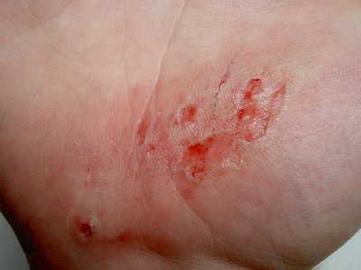 Abrasion (Medical)