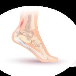 Achilles Tendinitis