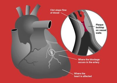 Acute Coronary Syndrome