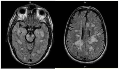 Acute Disseminated Encephalomyelitis