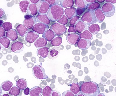 Acute Myeloid Leukemia