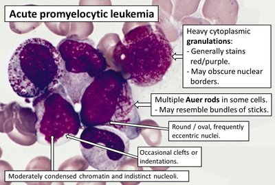 Acute Promyelocytic Leukemia