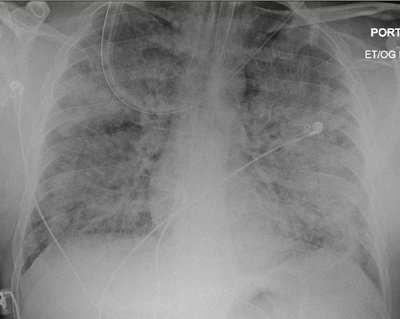 Acute Respiratory Distress Syndrome