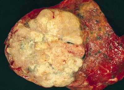 Adenocarcinoma Of The Lung