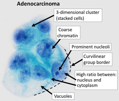 Adenocarcinoma