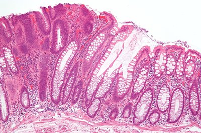 Adenoma