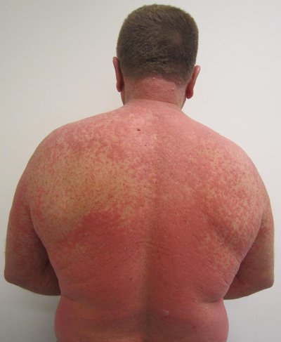 Adverse Drug Reaction