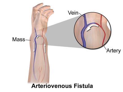 Arteriovenous Fistula