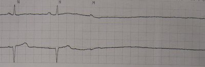 Asystole