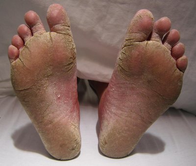 Athlete's foot