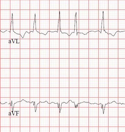 Atrial fibrillation