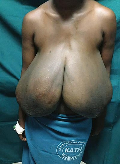 Breast Hypertrophy