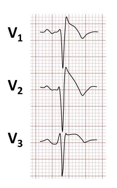 Brugada Syndrome