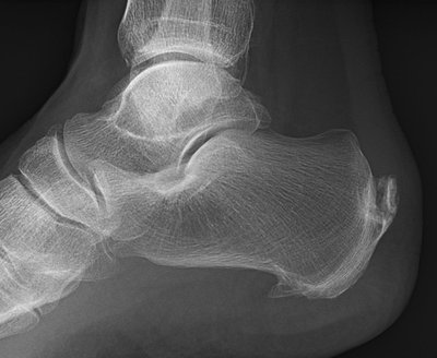 Calcaneal Spur