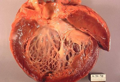 Cardiomyopathy