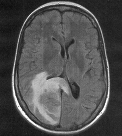 Cerebral Edema