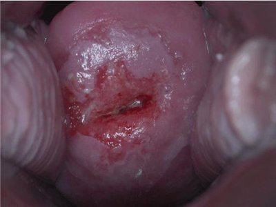 Cervical Intraepithelial Neoplasia