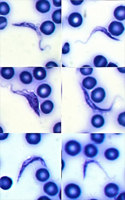 Chagas Disease