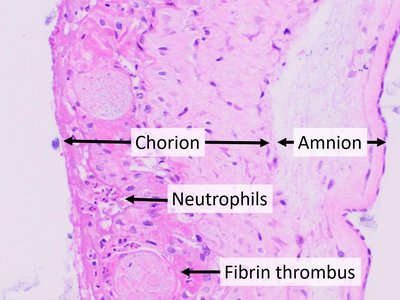 Chorioamnionitis
