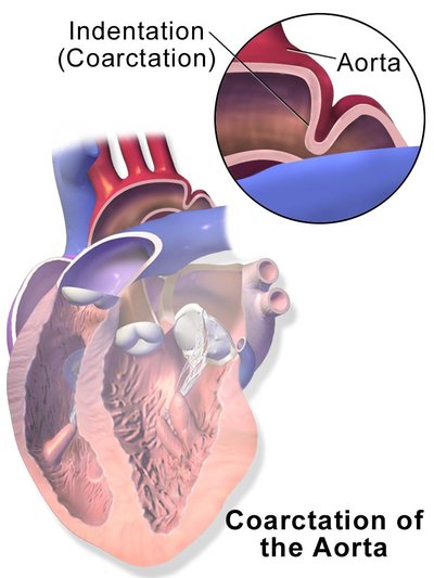 Coarctation Of The Aorta