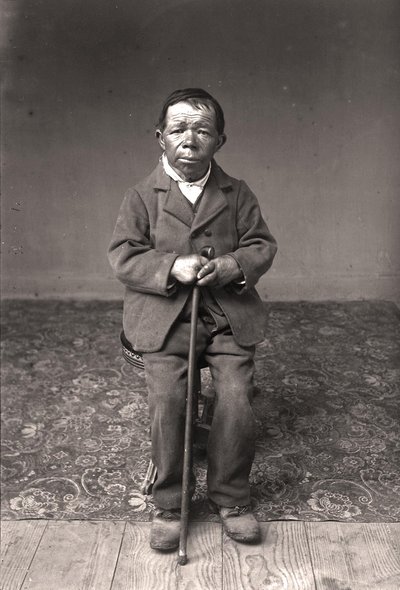 Congenital Iodine Deficiency Syndrome