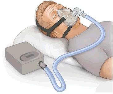 Continuous Positive Airway Pressure