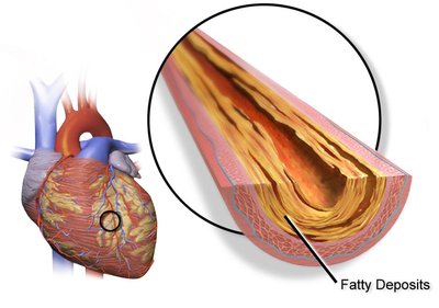 Coronary Artery Disease