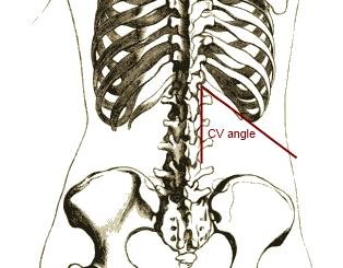 Costovertebral Angle Tenderness