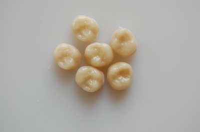 Crown (Dental Restoration)
