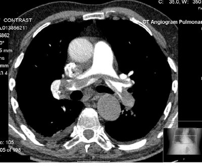CT pulmonary angiogram