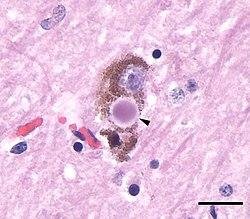 Dementia With Lewy Bodies