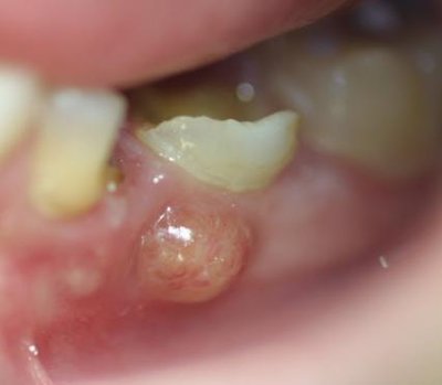 Dental Abscess