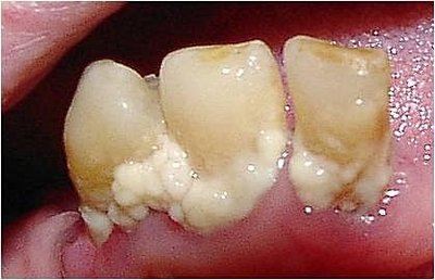 Dental Plaque