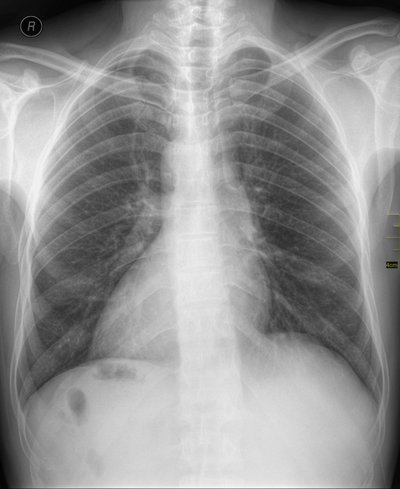 Dextrocardia