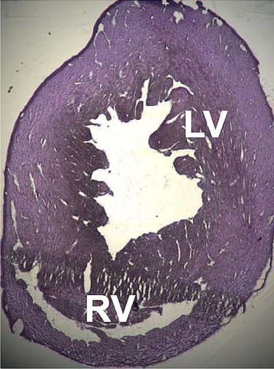 Dilated Cardiomyopathy