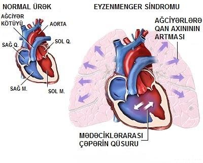 Eisenmenger's syndrome