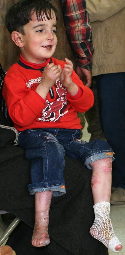 Epidermolysis Bullosa
