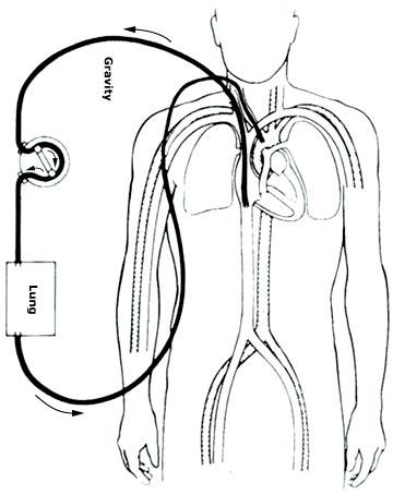 Extracorporeal Membrane Oxygenation