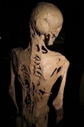 Fibrodysplasia Ossificans Progressiva