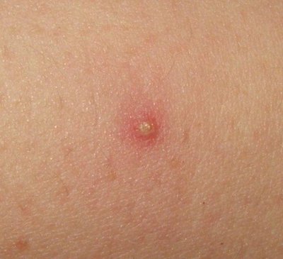 Folliculitis
