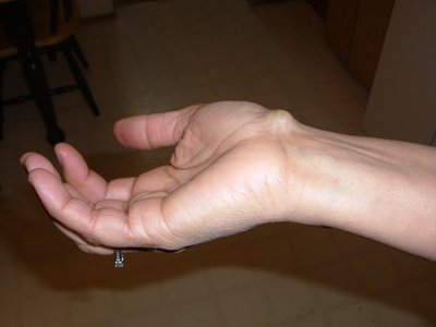Ganglion Cyst