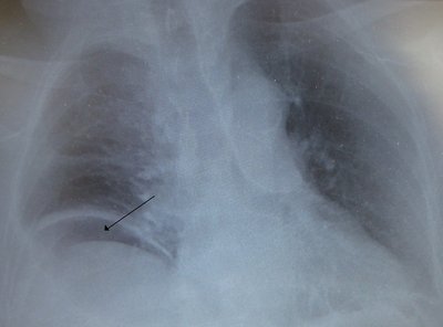 Gastrointestinal Perforation