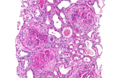 Goodpasture Syndrome