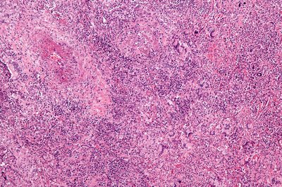Granulomatosis With Polyangiitis
