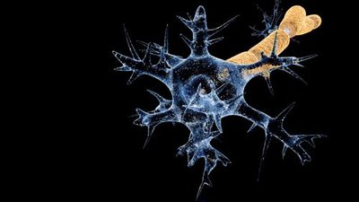 Guillain–Barré syndrome