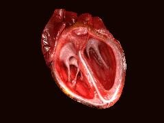 Heart Valve