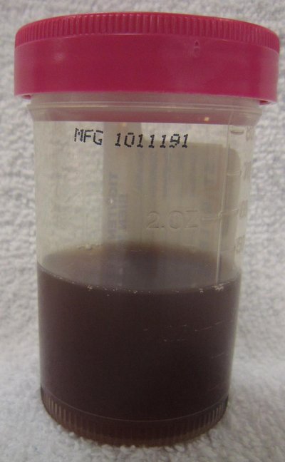 Hematuria