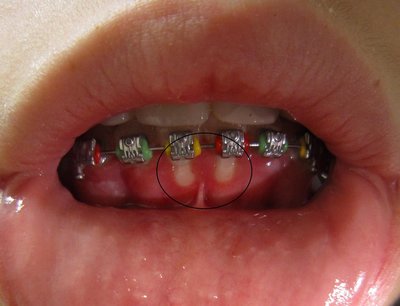 Herpetic gingivostomatitis