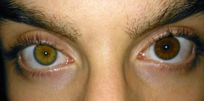 Heterochromia Iridum
