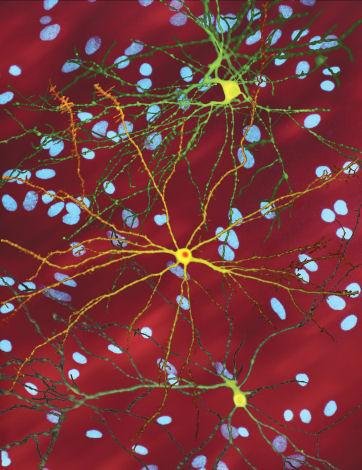 Huntington's disease
